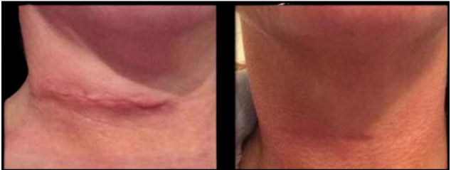 Before-and-after view of a neck scar. The scar fades and is less visible after treatment.