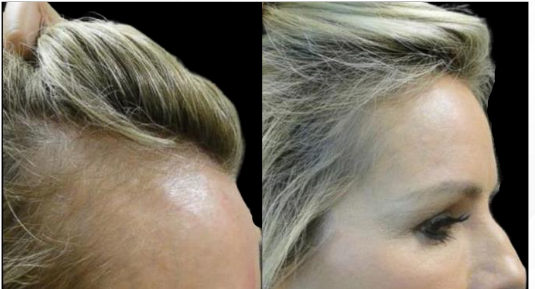 Blonde woman, receding hairline before and after hair restoration treatment; profile view, black background.