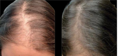 Before and after comparison of hair growth, showing a woman's scalp with thinning hair and improved hair density.