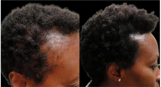 Before and after of black woman's hairline, showing hair growth in treated area.