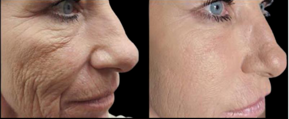 Side-by-side comparison: Aged face with wrinkles, then smooth skin after a treatment.
