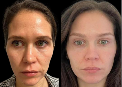 Side-by-side photos of a woman's face, before and after a cosmetic procedure, showing a smoother, more youthful appearance.