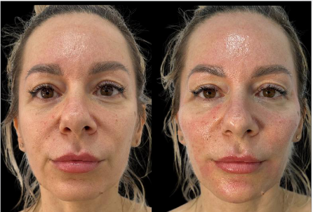 Woman's face before and after facial treatment, showing redness and possible needle marks.