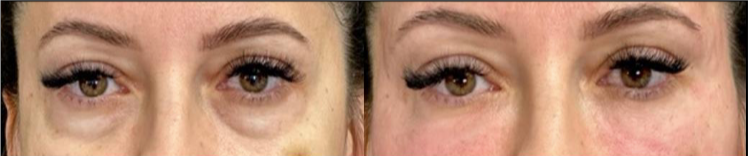 Before and after of eyes, showing a reduction in under-eye bags.