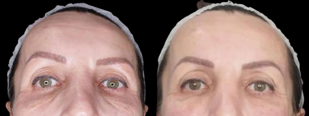 Side-by-side before-and-after photos of a woman's face; wrinkles are less visible in the