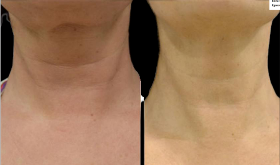 Neck comparison: before and after view. Skin appears tighter with reduced wrinkles and improved definition.