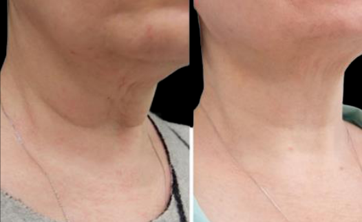 Before and after photos of a person's neck, showing a reduction in wrinkles.