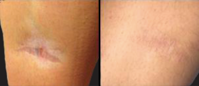 Before and after photos of a scar on skin. The first image shows a raised scar, while the second shows the scar faded.