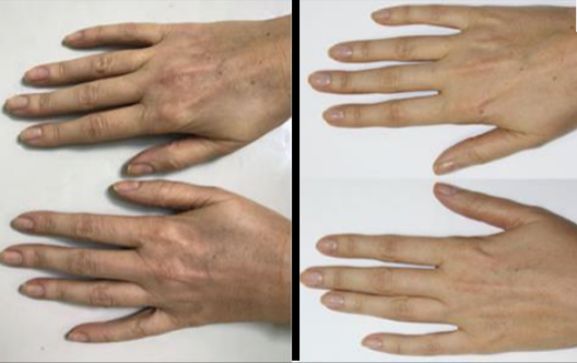 Two sets of hands; left hands have skin discoloration, right hands are clear.