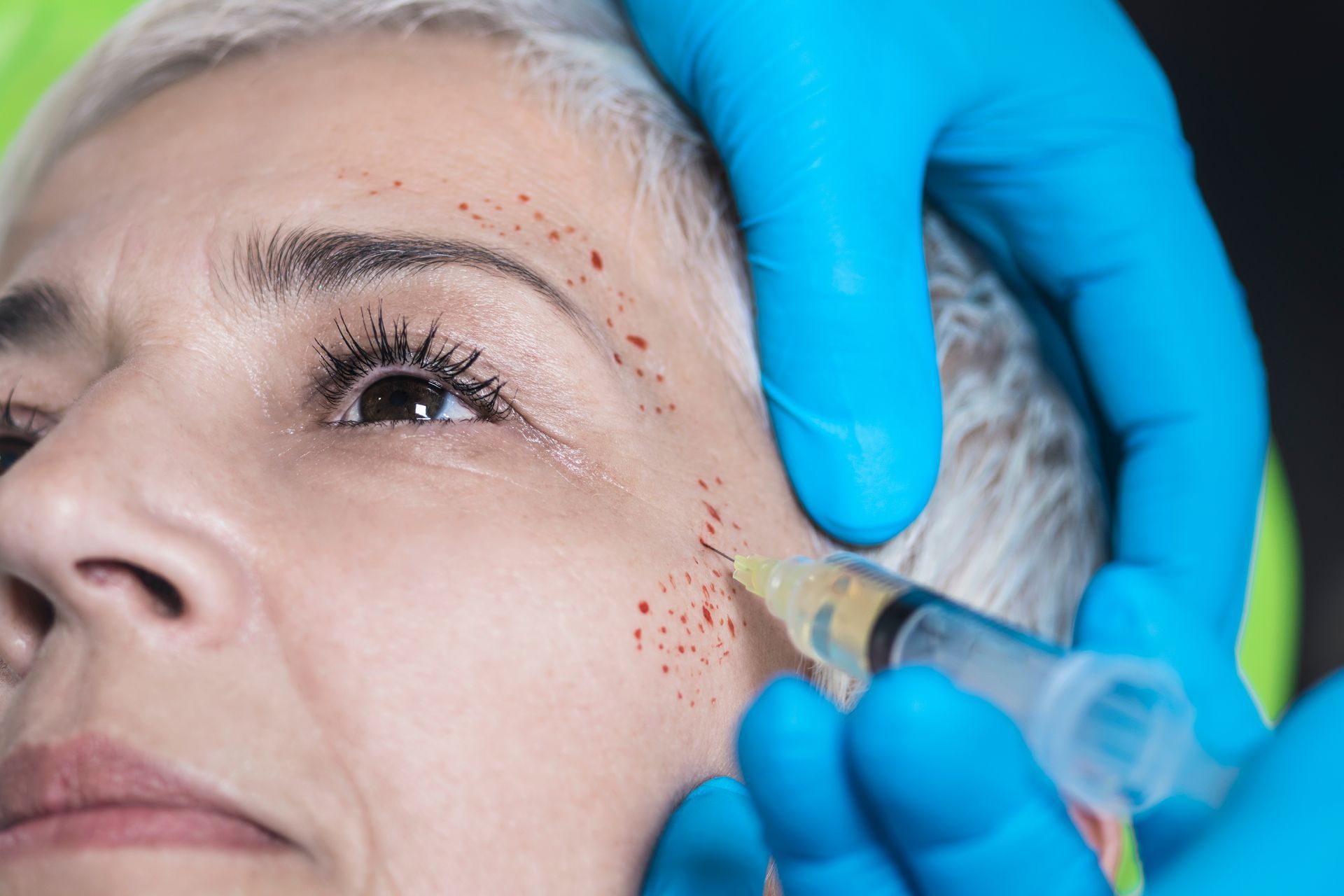 A woman is getting a botox injection in her forehead.