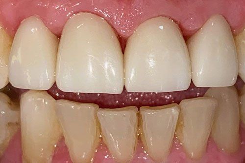 After invisalign treatment Cicinnati OH