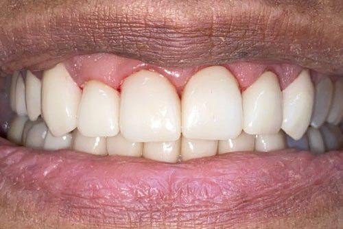 After invisalign treatment Cicinnati OH