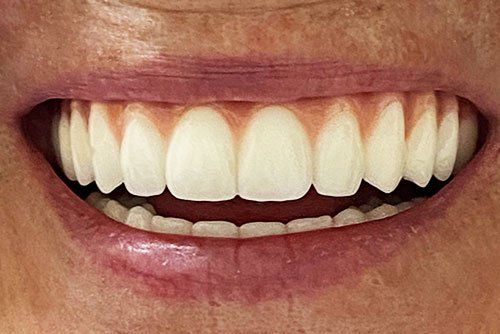 After invisalign treatment in Cicinnati OH