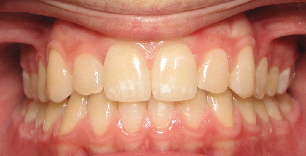 After porcelain veneer treatment Montgomery OH