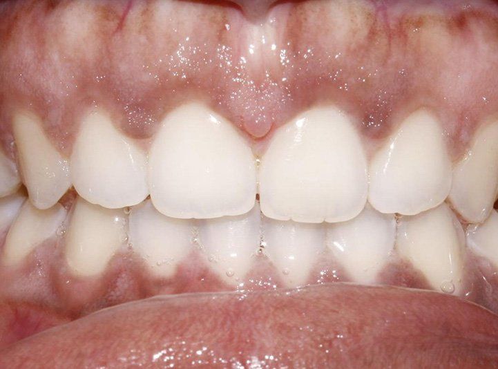A Close-Up Shot of a Person’s Teeth | Dental Office Cincinnati