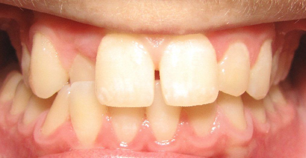 Porcelain Veneers Treatment Dentist Montgomery OH