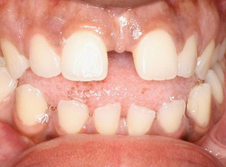A Gap Between the Upper Front Teeth | Dental Office Cincinnati