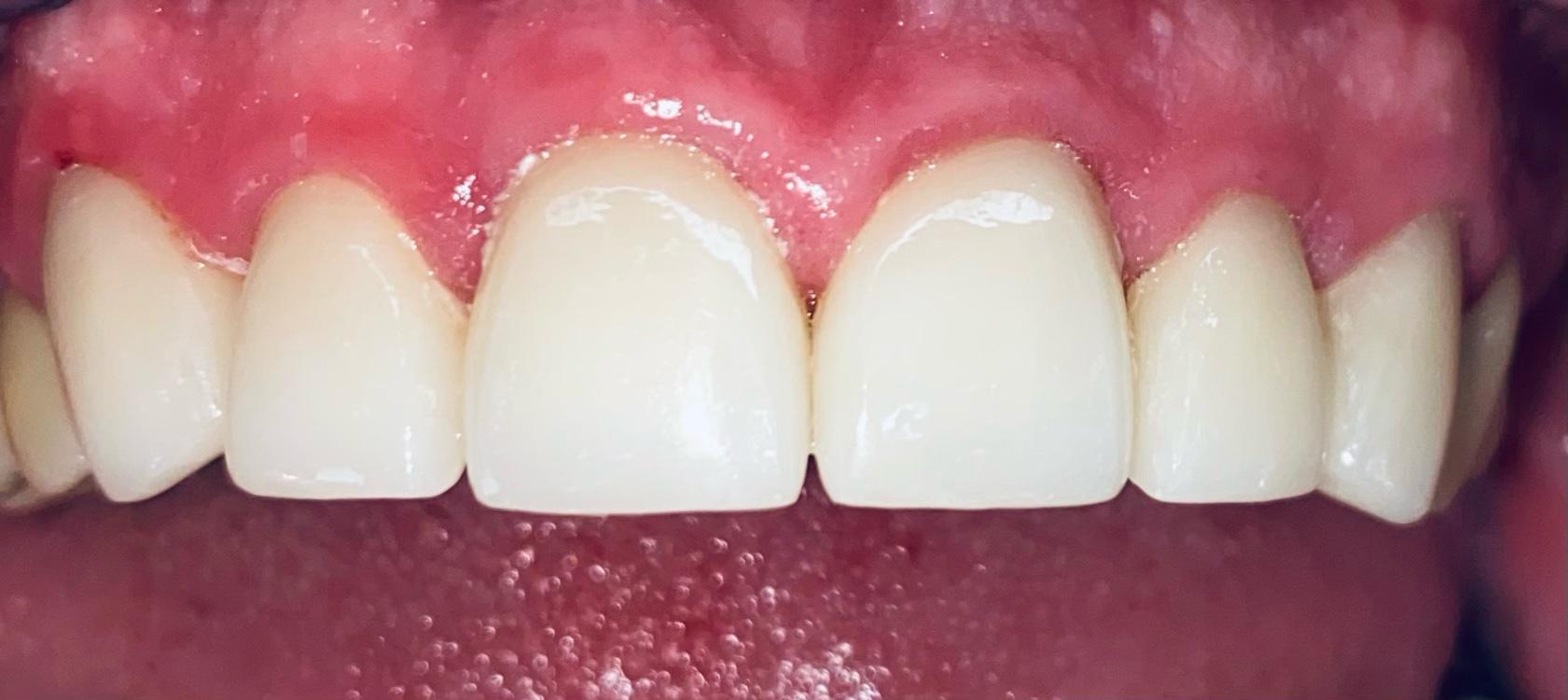 After Ceramic Bonding Treatment Dentist Montgomery, OH