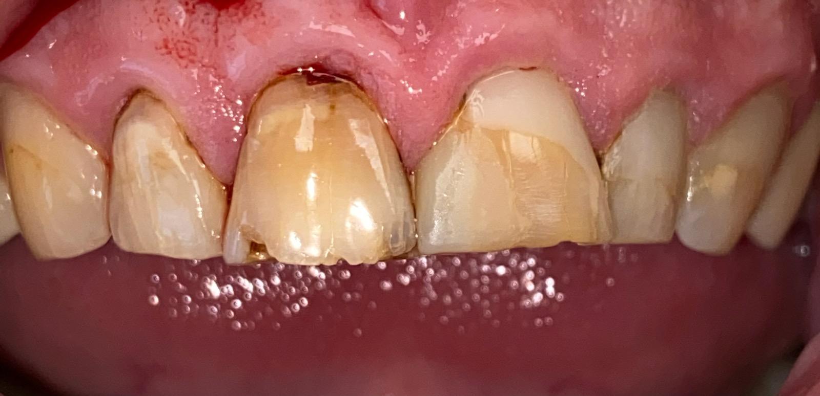 Before Ceramic Bonding treatment Dentist Montgomery OH