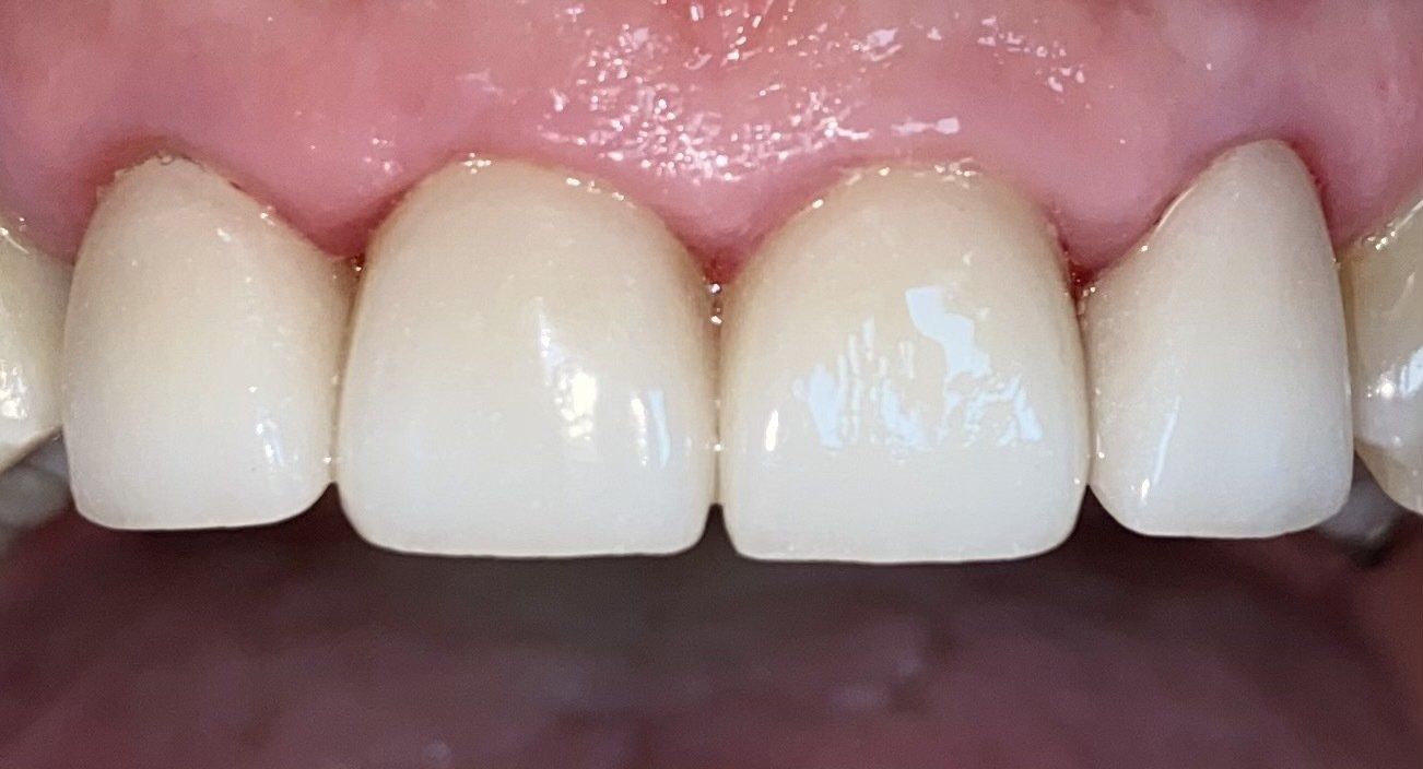 After invisalign treatment Cicinnati OH