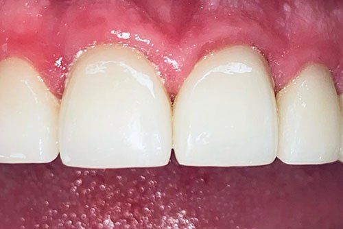 After invisalign treatment Cicinnati OH