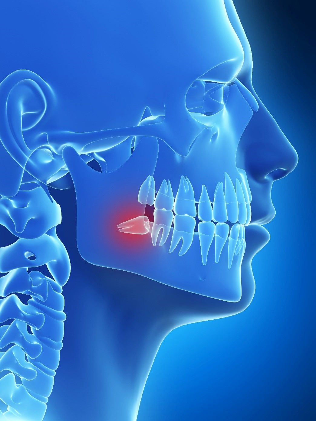 Wisdom Tooth 101: Understanding Impacted Wisdom Teeth