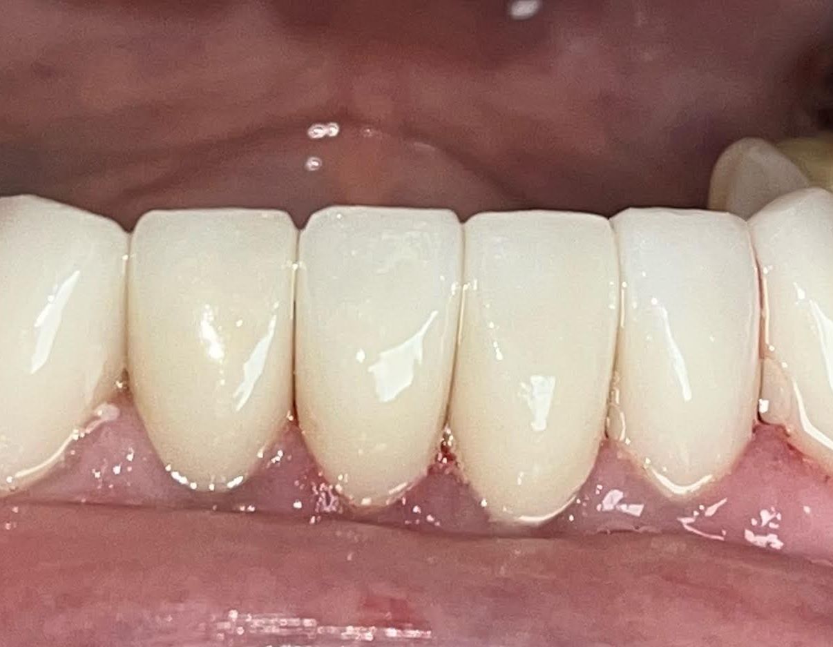 After invisalign treatment Cicinnati OH