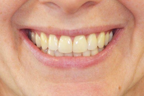 After invisalign treatment Cicinnati OH