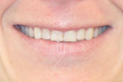 After invisalign treatment Cicinnati OH