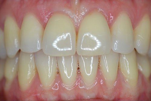 After invisalign braces in Cicinnati OH