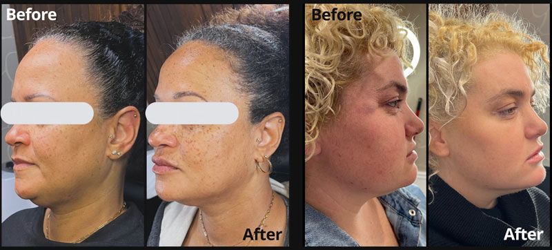 Before and after botox & dermel filler treatments