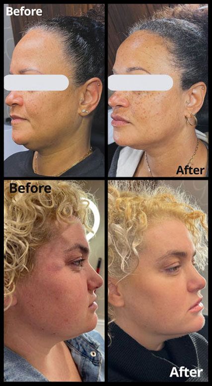 Before and after botox & dermel filler treatments