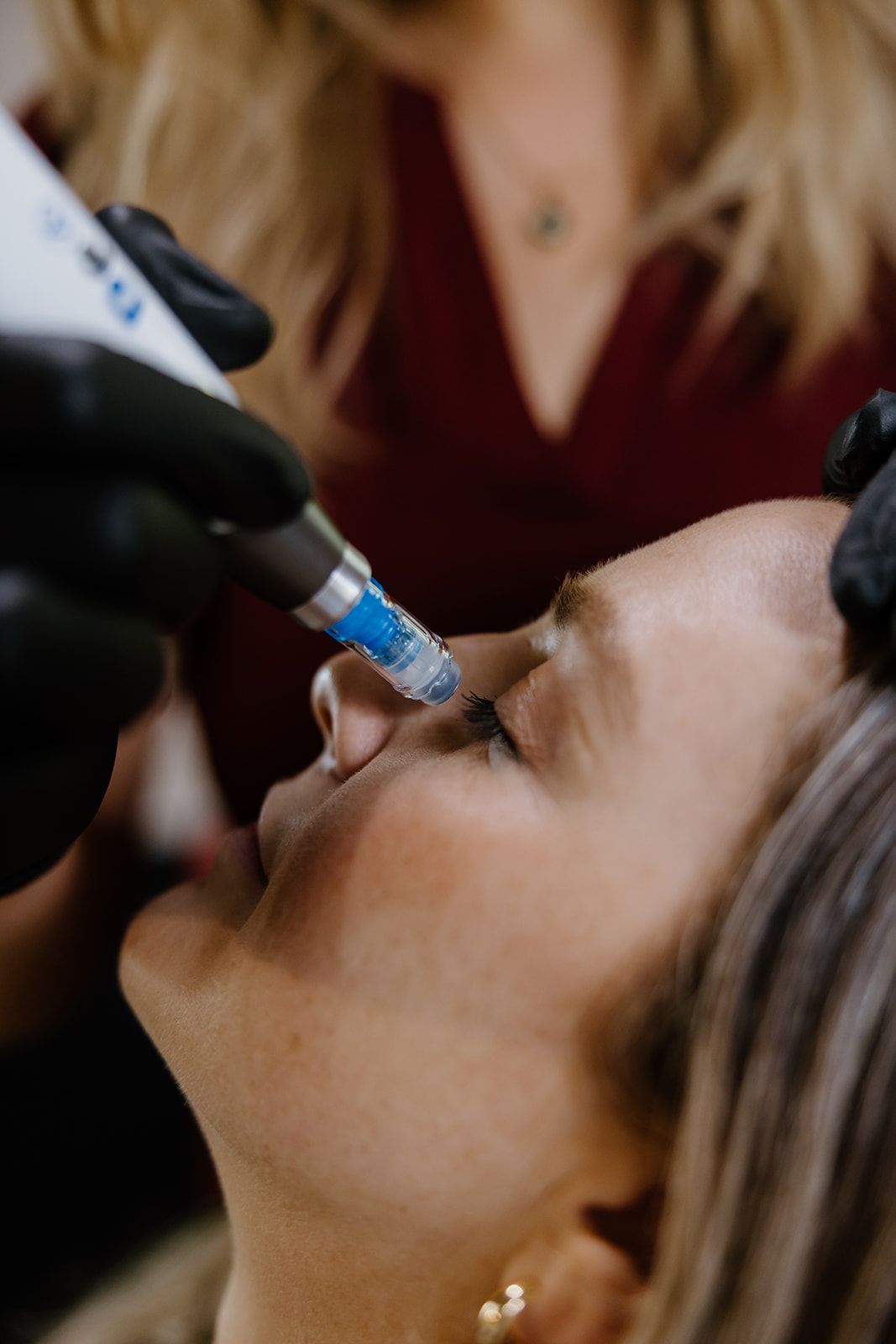 A woman is getting a microneedling treatment.