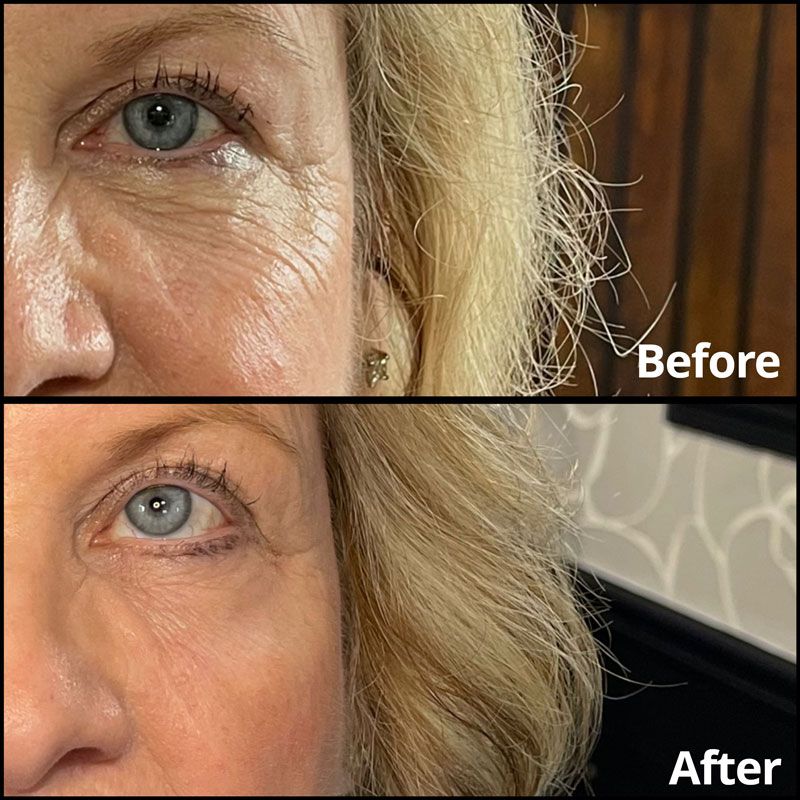 Smootheye before and after treatment.