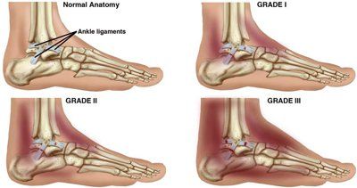 A Guide to Ankle Sprains