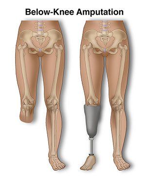 Physical Therapist's Guide to Below-Knee Amputation