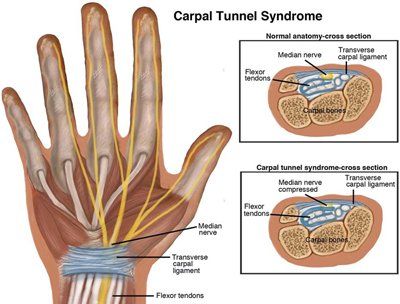 Physical Therapist's Guide to Carpal Tunnel Syndrome