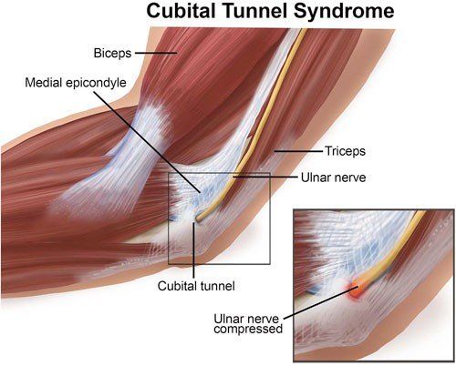 Ulnar Nerve Pain in Your Elbow or Wrist