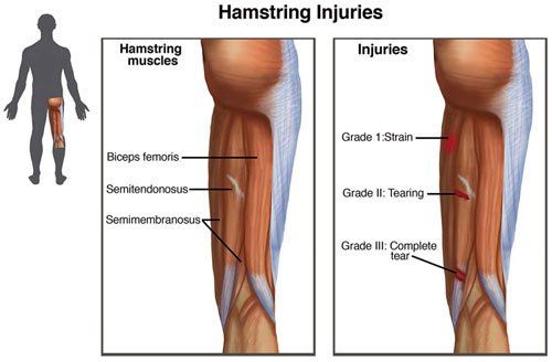 Hamstring Injuries - Symptoms and Causes