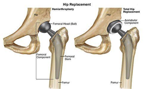 physiotherapy after hip surgery