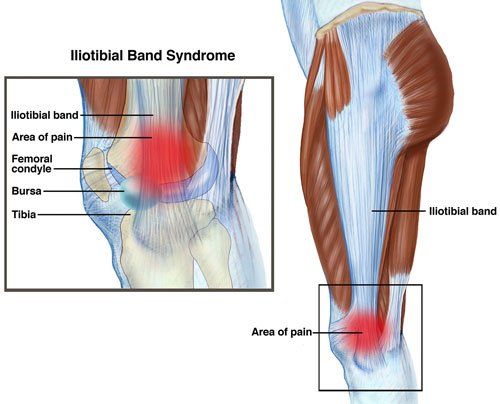 III. Recognizing the Symptoms of IT Band Syndrome