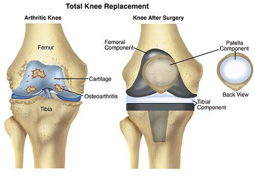Physical Therapist's Guide to Total Knee Replacement (Arthroplasty)
