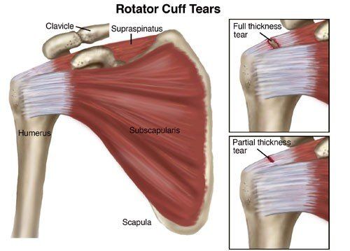 Shoulder Surgery Support Group (Rotator Cuff Tears & arthritis) Public  Group