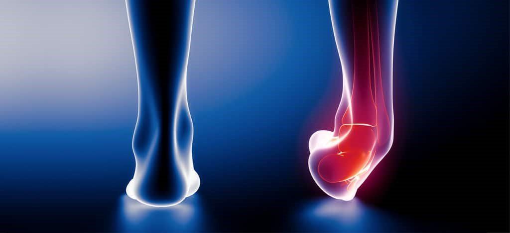 Physical Therapist's Guide to Ankle Sprain