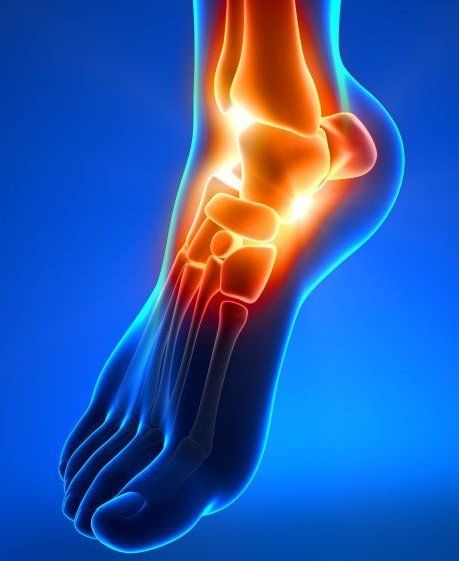 Physical Therapist's Guide to Ankle Fracture