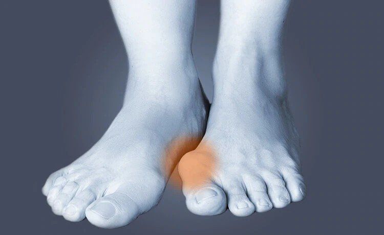 Physical Therapist's Guide to Bunion (Hallux Valgus)