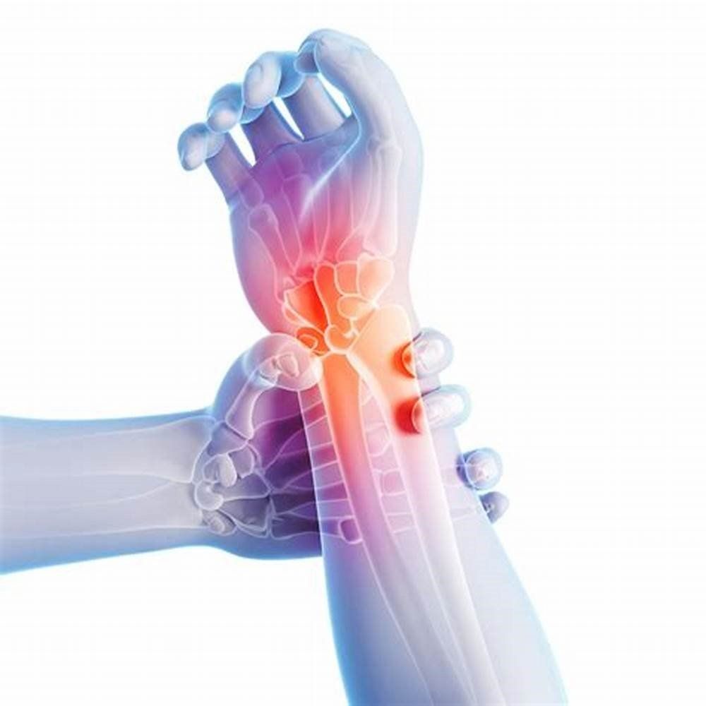 Physical Therapists Guide to Carpal Tunnel Syndrome picture