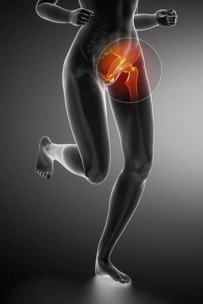 Groin Pain. Structures and conditions that can contribute to groin