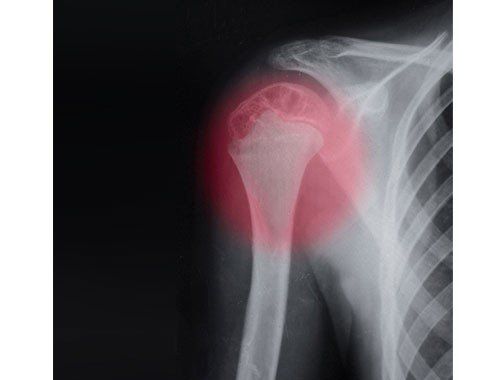 Humerus Fracture - Broken Upper Arm - Little Rock, AR & North Little Rock,  AR: Martin Orthopedics