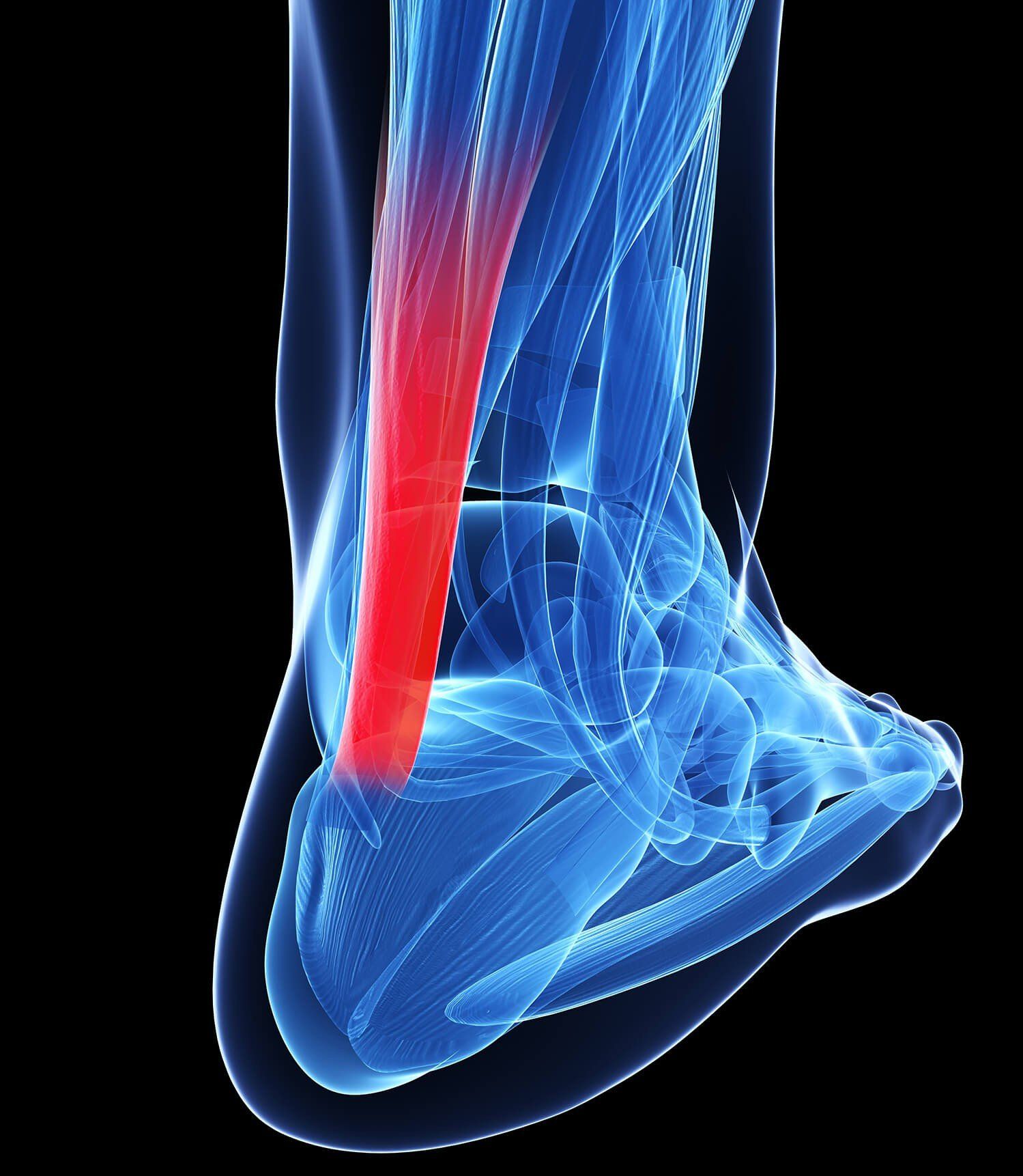 Physical Therapists Guide to Peroneal Tendinopathy